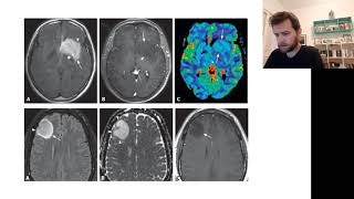 Oligodendroglioma  Resuminho rapidão [upl. by Ilrebmik97]