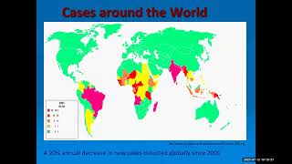 quotHansens Disease aka Leprosy 2023 Updatequot Erik Gilbertson MD [upl. by Acilgna556]