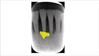 Advanced Bone Loss in the Lower Anterior Teeth [upl. by Alejna]