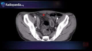 Comb sign of Crohns disease  radiology video tutorial CT [upl. by Gimpel]