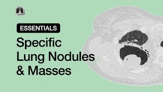 Specific Lung Nodules amp Masses  Chest Radiology Essentials [upl. by Olyhs]