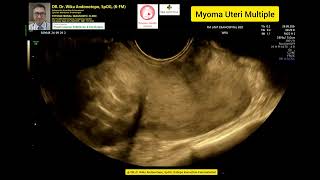 Myoma Uteri Multiple [upl. by Nnanaej]