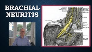 Brachial Neuritis  Parsonage Turner Syndrome [upl. by Ayanal947]