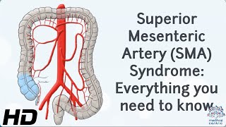 From Diagnosis to Recovery A Journey through Superior Mesenteric Artery Syndrome [upl. by Alethea]