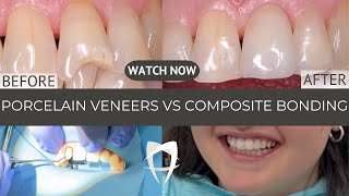 Porcelain Veneers vs Composite Bonding 2024 Comprehensive Comparison of Smile Makeover Options [upl. by Llenehs]