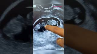 Early pregnancy scan  pregnancy confirmation  twin pregnancy  gynaecologist doctorsvlogs [upl. by Acinorej18]