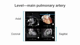 How to identify normal heart structures on a cardiac CT scan [upl. by Mani123]