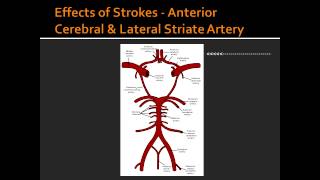 Effects of Strokes  Anterior Cerebral amp Lateral Striate Artery [upl. by Jeb]