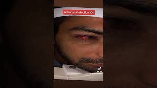 Adenoviral Eye Infection pinkeye ashobechashm ashob eye eyecarecentre eyedisorder lashes [upl. by Cavanaugh]