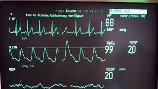 Ventricular Extrasystoles [upl. by Adolfo135]