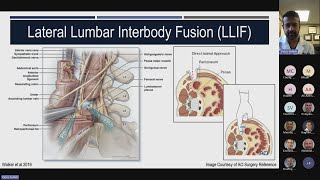 Neuromonitoring during LLIF The Past the Present and the Future presented b Ashish Patel MD [upl. by Karney]