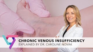 Complete Guide to Chronic Venous Insufficiency  NY Top Varicose Vein Specialist Manhattan 10017 [upl. by Nyssa]