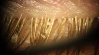 Demodex Mites Removed from Eyelid Eyelashes [upl. by Leif21]