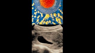 Anembryonic Pregnancy  Blighted Ovum   Pregnancy with Empty Gestational Sac ultrasound [upl. by Euqinitram]