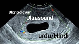 Blighted OvumAnembryonic Pregnancy on ultrasound [upl. by Yennor]