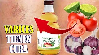 🍅👩 LAS VARICES SE PUEDEN ELIMINAR Y QUITAR CON REMEDIOS CASEROS NATURALES [upl. by Pacificia]