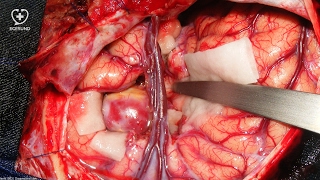 Was ist eine Hirnblutung Wie behandelt man ein Aneurysma im Kopf [upl. by Eselahs]