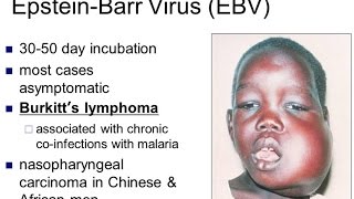 Burkitt Lymphoma [upl. by Bonns]