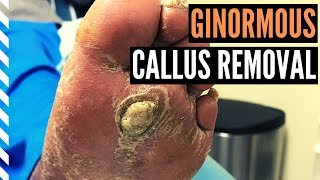 Ginormous Callus Removal [upl. by Mila]