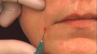 Instructions on Filling Nasolabial Folds With Dermal Fillers [upl. by Eocsor13]