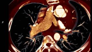 CT Dynamic Aortic Valve [upl. by Icram]