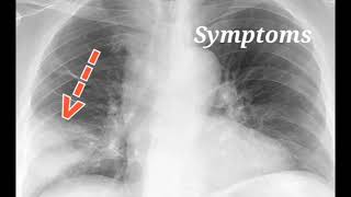 Lobar pneumonia  Symptoms Treatment and prevention [upl. by Gagnon]