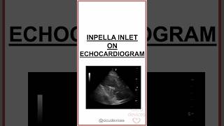 IMPELLA CP INLET ON ECHOCARDIOGRAM impella [upl. by Ainotna253]