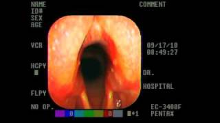 Early Arytenoid chondritism4v [upl. by Venus]