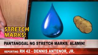 PANTANGGAL NG STRETCH MARKS ALAMIN [upl. by Itra227]