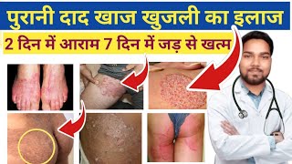 जांघों की दाद खाज खुजली खत्म  Home Remedies For Itching in Private Parts  Fungal infection [upl. by Demy169]