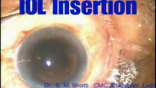 Extracapsular cataract extraction [upl. by Peednas901]