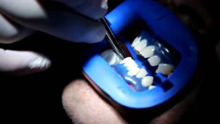 How is Laser Teeth Whitening Done  Teeth whitening in Toronto [upl. by Iphigeniah]