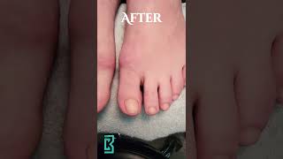 LCN Barefoot Toenail Restoration [upl. by Bello549]