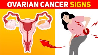 9 Warning Signs of Ovarian Cancer Every Woman Should Know [upl. by Lyj]