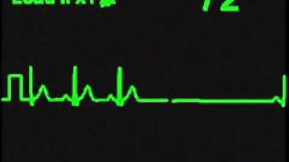 Sinus Exit Block [upl. by Ermine]