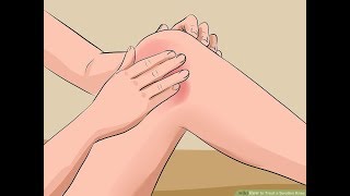 How to Treat a Swollen Knee  How to do treatment of knee joint  swollen knee [upl. by Sheeree]