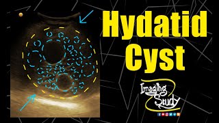 Hepatic Hydatid Cyst  Ultrasound  Case 149 [upl. by Edahs]