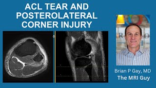 ACL TEAR WITH POSTEROLATERAL CORNER INJURY [upl. by Yuria518]