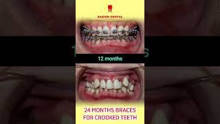 24 months braces for crooked teeth dentist dental dentalclinic nhakhoasaigoncenter [upl. by Nila]