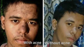 One of the biggest mistake ive made my acne scars [upl. by Amor901]