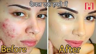 Kaylite Cream के फायदे और नुकशान Full Review in hindi [upl. by Ysset]