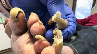 Unbelievable Toenails so long and painful that patient cannot walk [upl. by Metcalf]