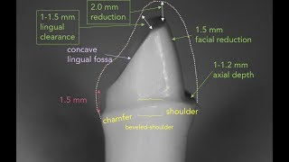 Anterior PFM Preparation  Dr Richard Stevenson [upl. by Nathanson]