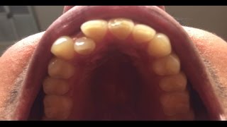 Tooth Extraction for 4 teeth  Adult Braces [upl. by Naloj]