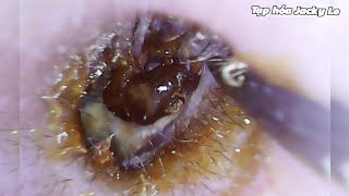 Ear Wax Removal 145 Earwax that is too big and wet is very itchy  Ear Cleaning ASMR [upl. by Kendry]