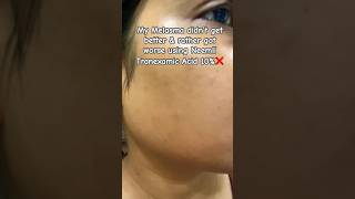 I had high hopes from this 10 Tranexamic Acid❌🥹 Melasma amp hyperpigmentation Journeyshorts [upl. by Mercado]