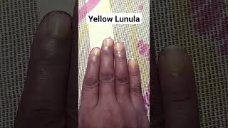 Yellow Lunula Chand 🌒 Sings in Hand Palmistry Dikki astrology palmistry astrology motivation [upl. by Noicnecsa183]