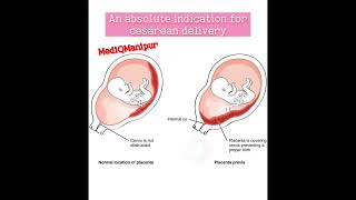 Placenta previa Cesarean sectiondoctor anatomy obstetrician nursing medicalstudent [upl. by Anirt]