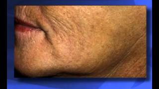 SCULPTRA EN EL REJUVENECIMIENTO FACIAL [upl. by Akemad269]