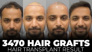 Get Rid of Hair Loss  Before and After Transformation  Cara Clinic [upl. by Townshend]